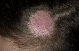 Заболевания кожи и волосистой части головы (Микроспория)