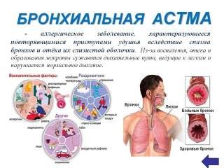 Бронхиальная астма.